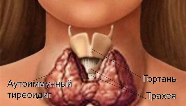 Аутоиммунный тиреоидит