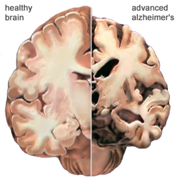 Изменения в мозгу при болезни Альцгеймера