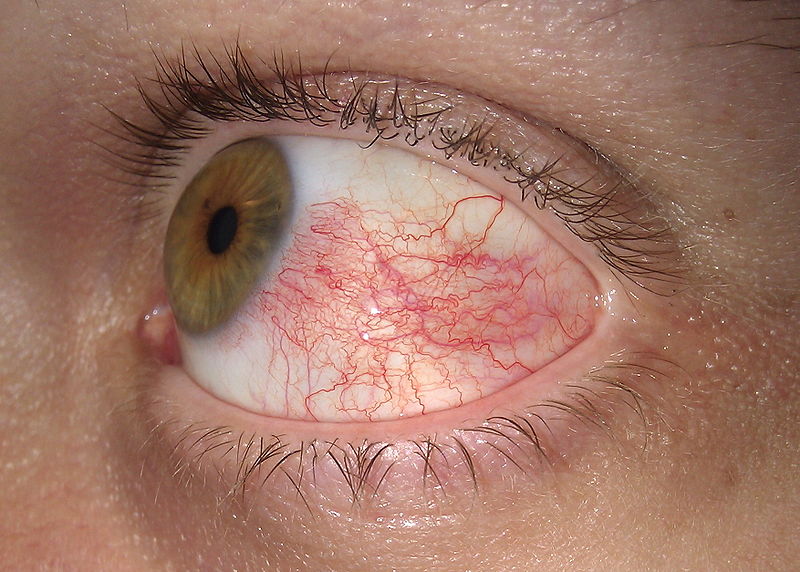 Красные сосуды в глаза означают повышенное давление