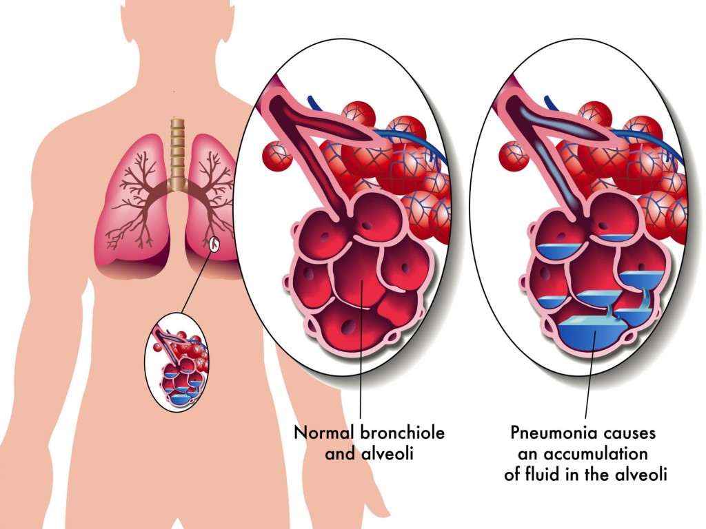 Пневмония - причины кашля