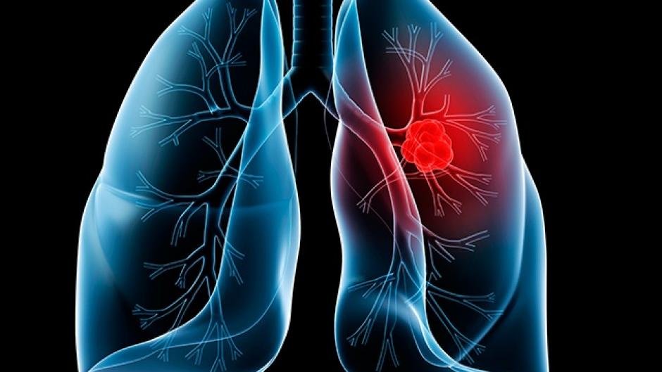 Окружающая среда, загрязнение воздуха тоже могут способствовать возникновению рака легких