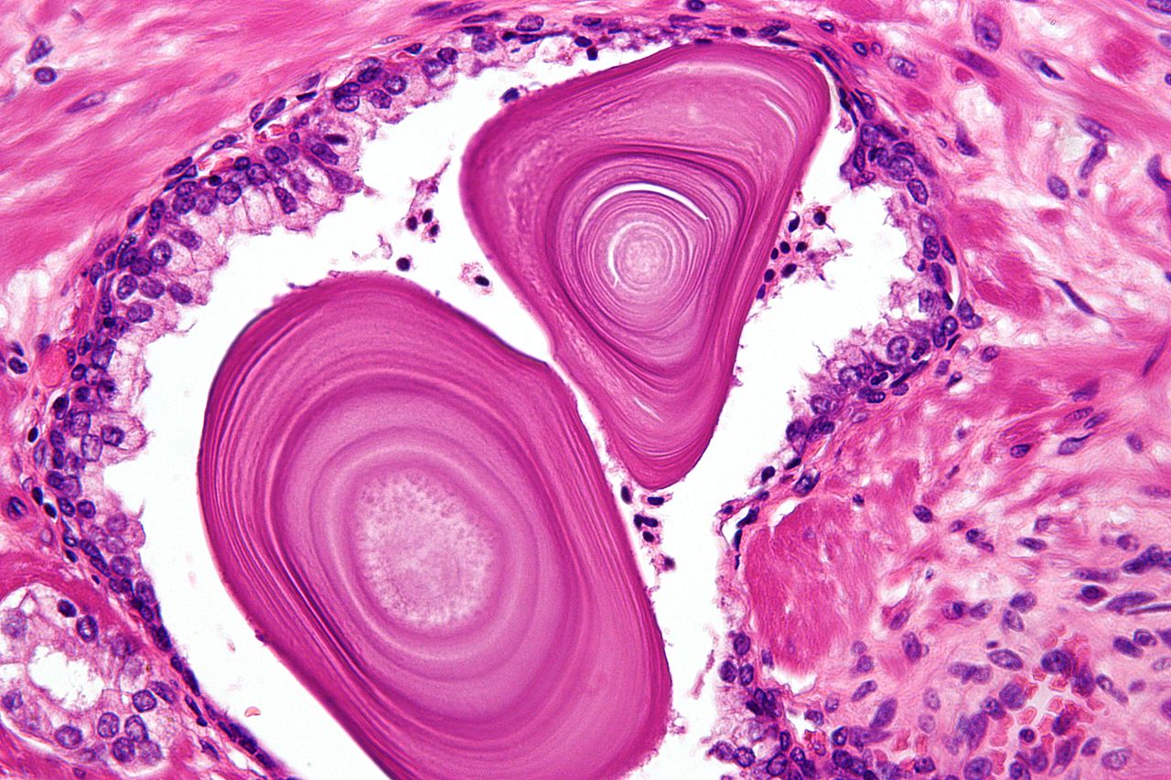 Камни предстательной железы под микроскопом