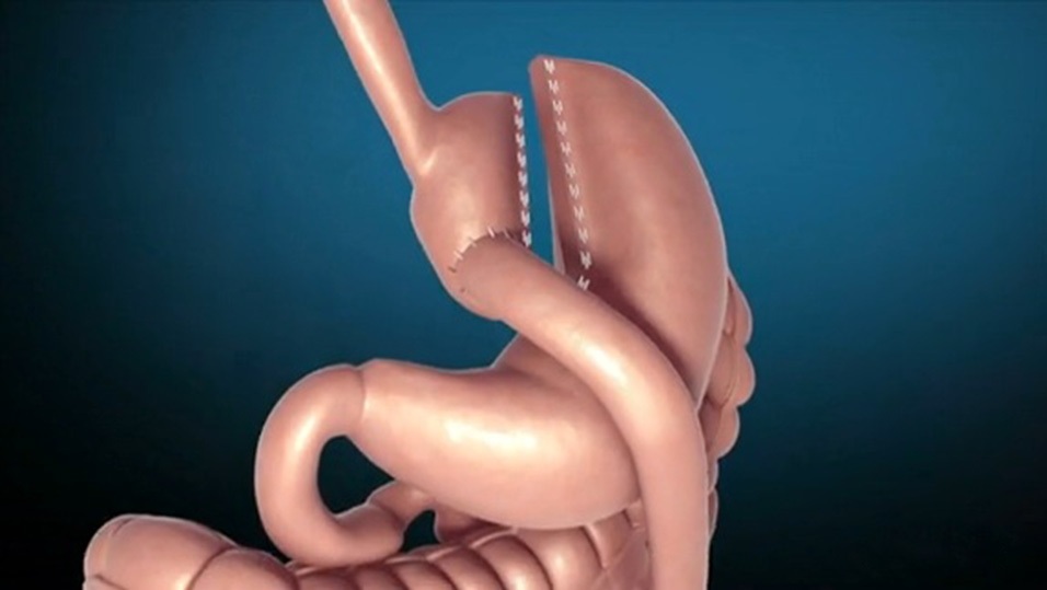 При шунтировании часть желудка отсоединяется от пищевода