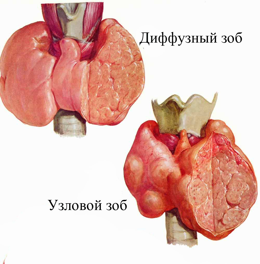 Воспалительные процессы приводят к изменениям структуры щитовидной железы
