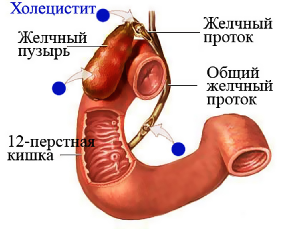 Холецистит желчного пузыря