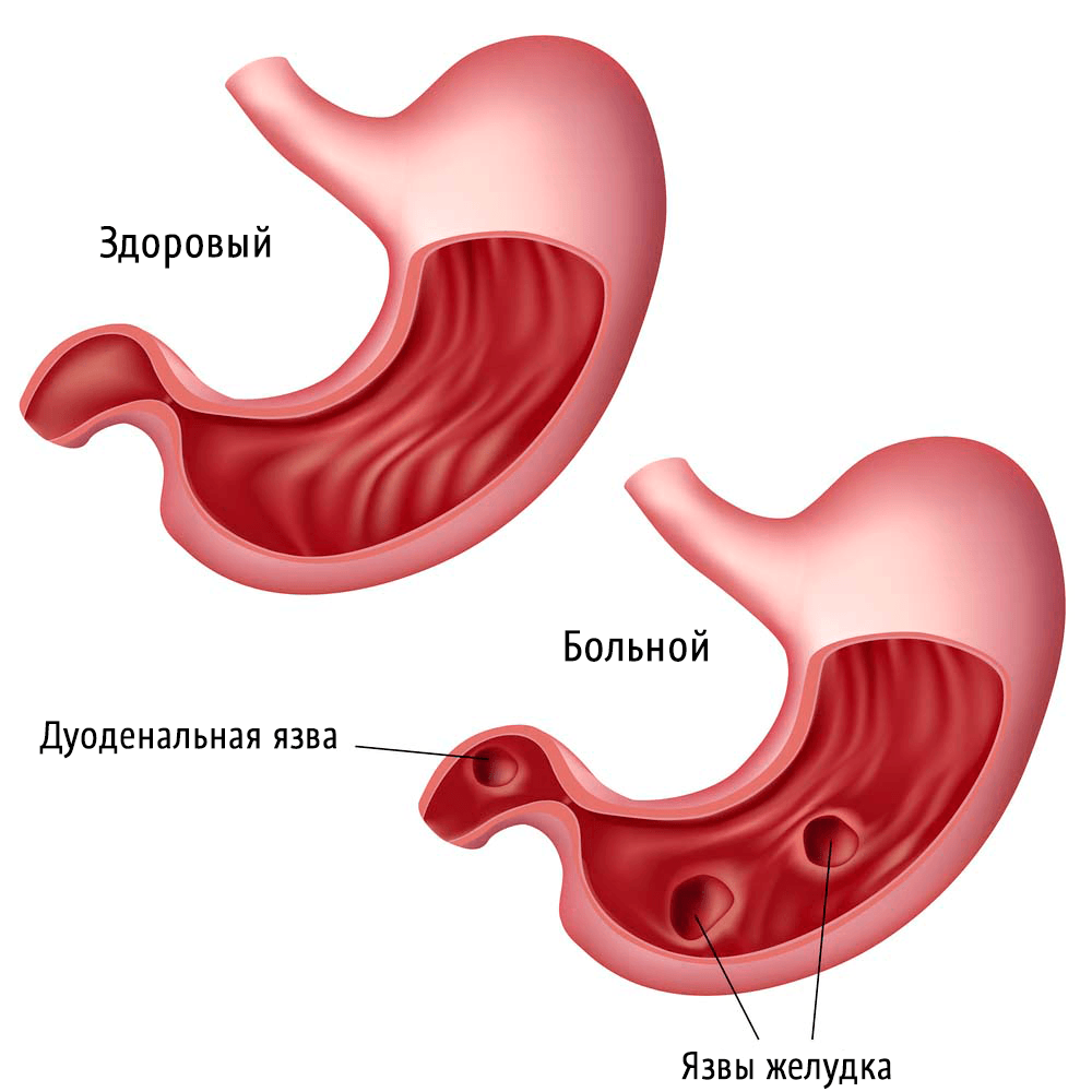 Схематическое изображение язвы желудка