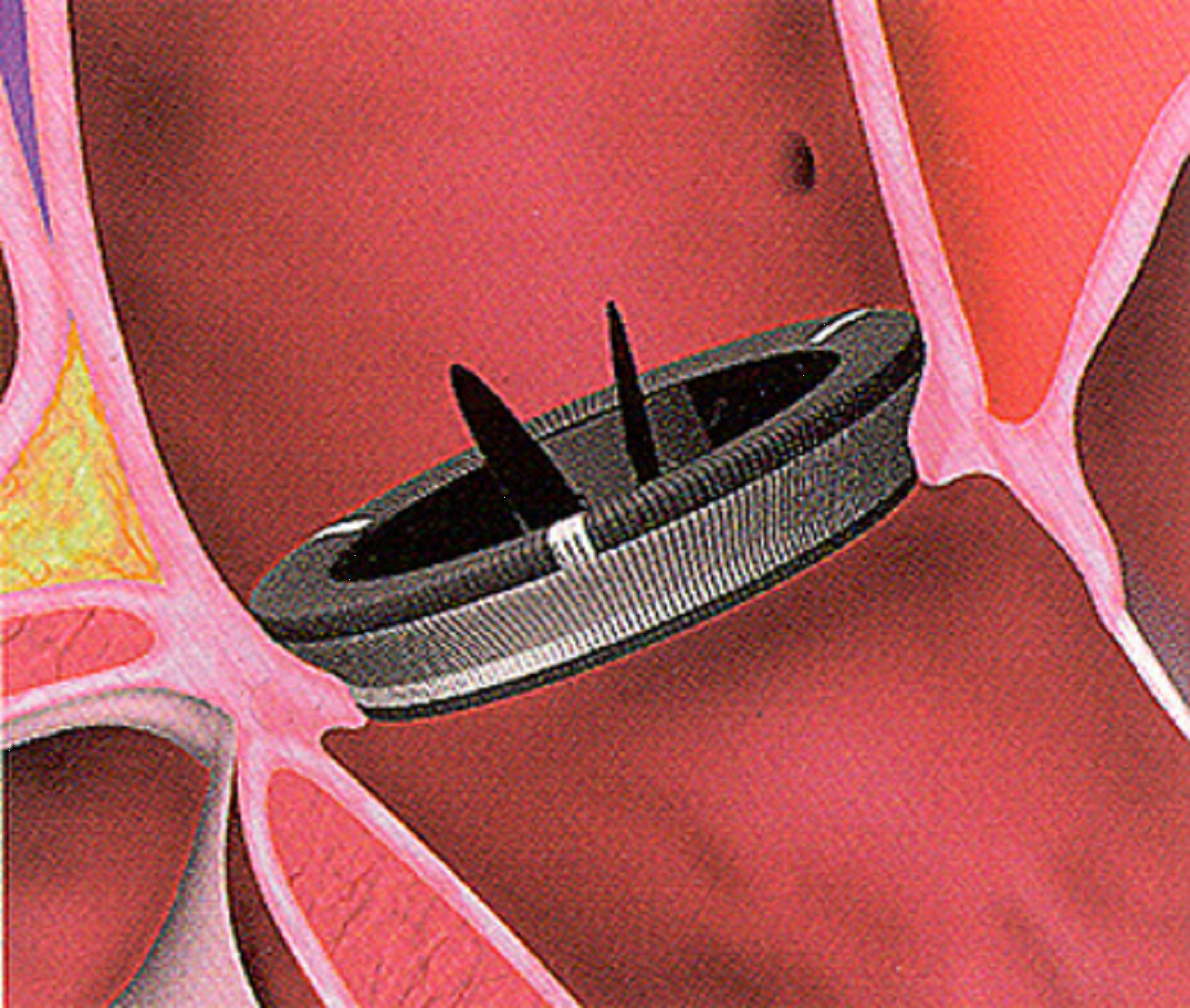 Протез аортального клапана