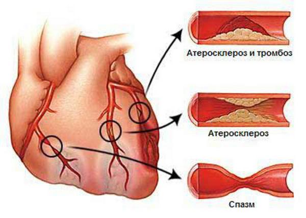 Сосуды сердца во время приступа стенокардии