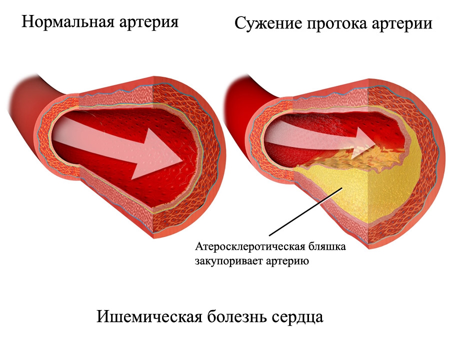 Сужения протока артерии