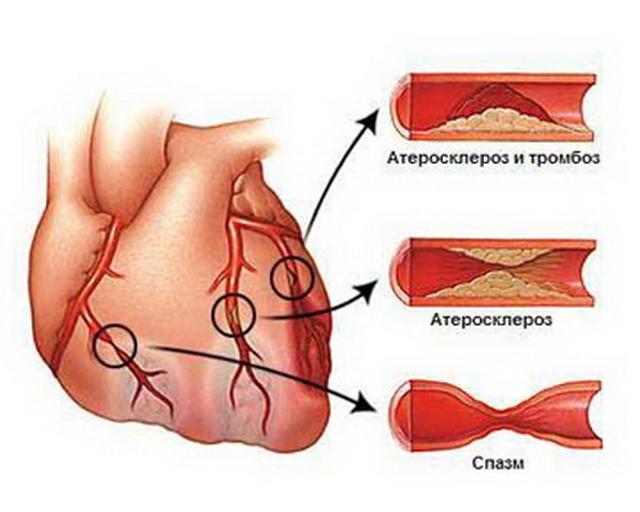 Атеросклероз - причина ишемической болезни сердца