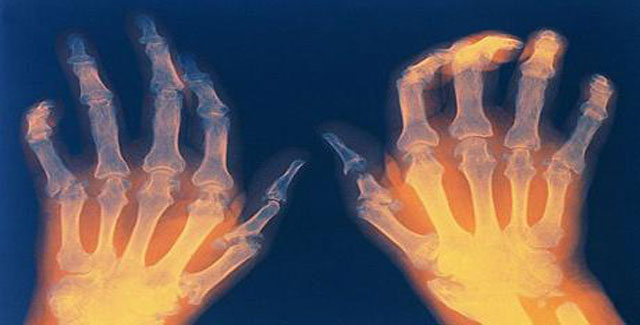 Рентгенограмма ревматоидного артрита