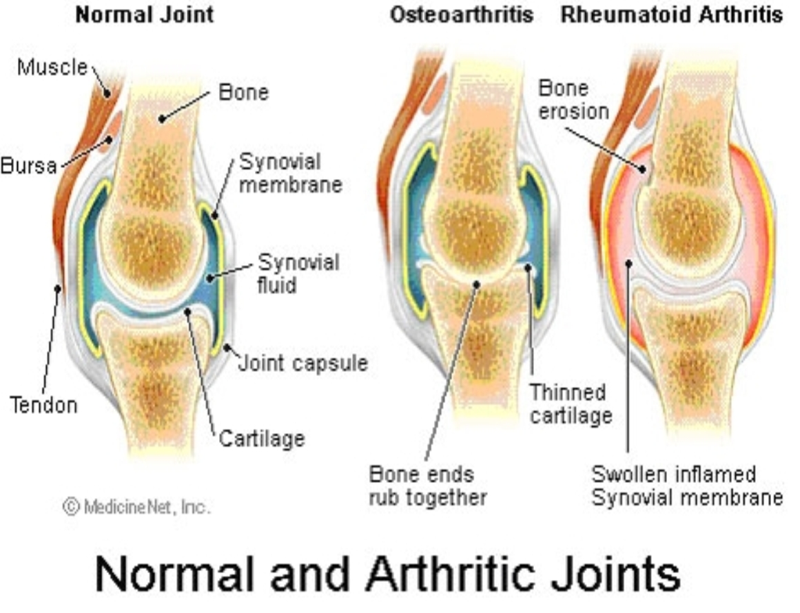 Схема здорового сустава, изменения при деформирующем остеоартрозе и ревматоидном артрите.