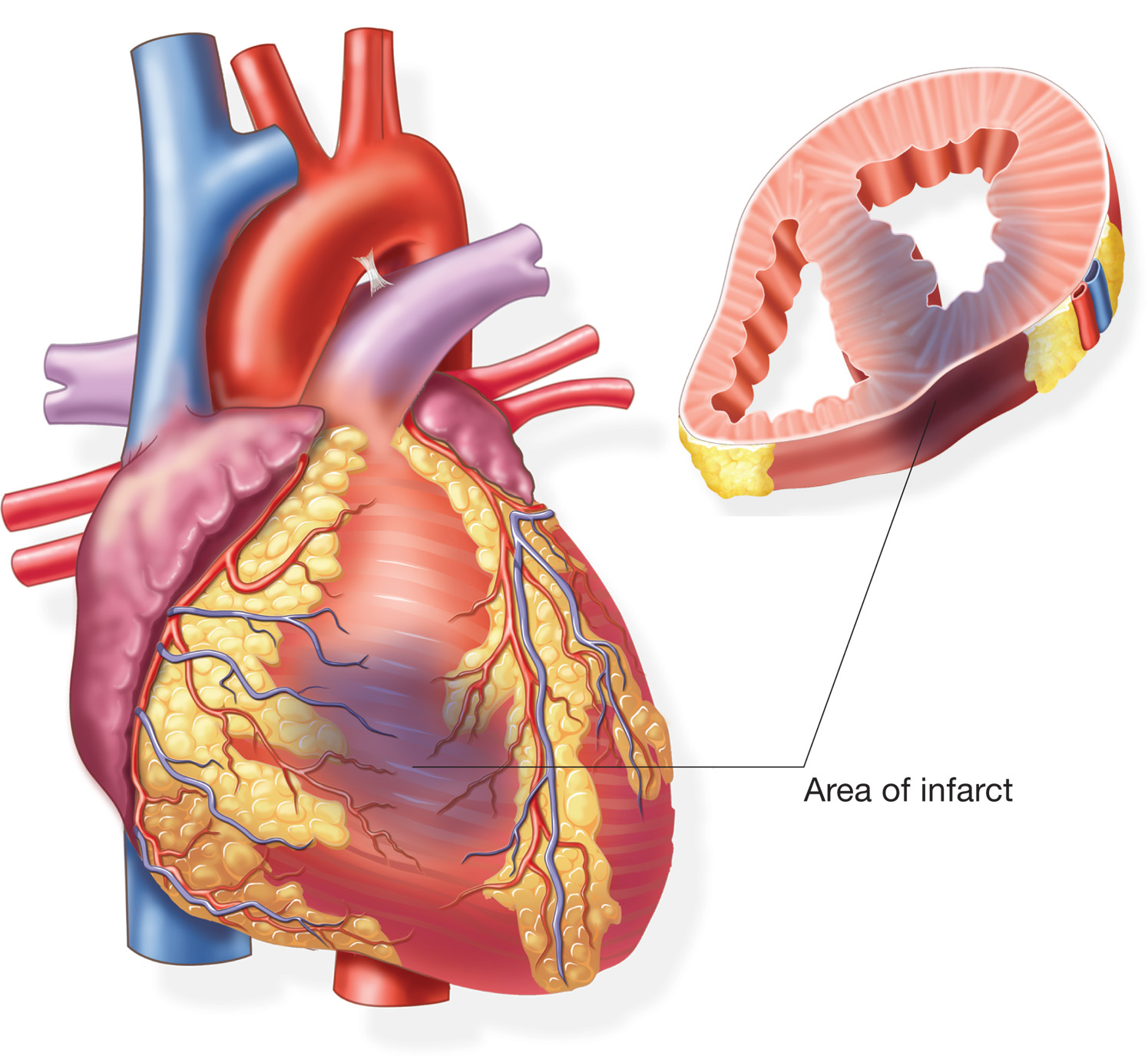 При инфаркте отмирает часть сердца